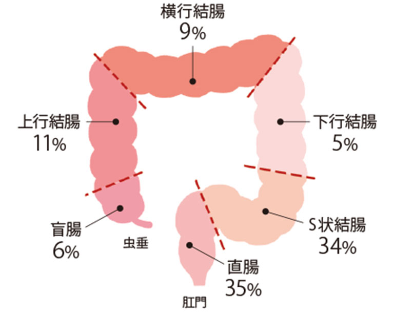 大腸がん