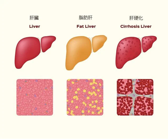 脂肪肝